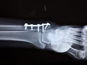 How Broken Bone Lawsuits are Filed in New York